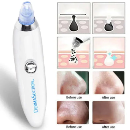 DermaGlow Suction Pro
